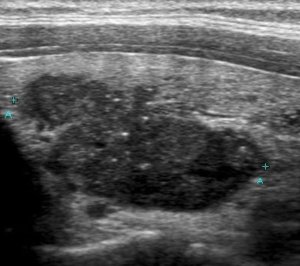 Nódulo tiroideo sospechoso en Ultrasonido: Bordes Irregulares y Calcificaciones